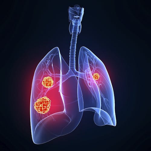 Un approccio molecolare per inquadrare meglio i tumori neuroendocrini del polmone