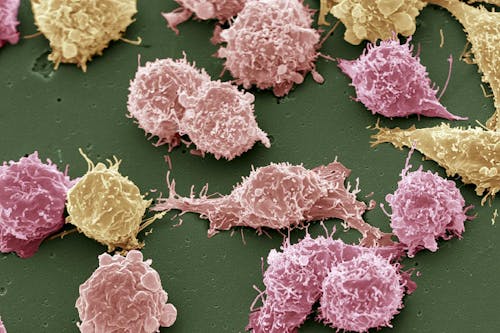 Cancro ovarico: ecco come si diffondono le metastasi