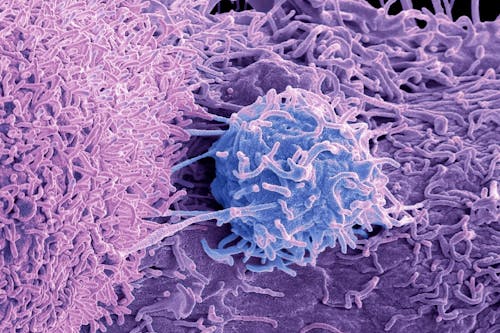 Tumore della prostata: nuove prospettive per aumentare la sensibilità alla radioterapia