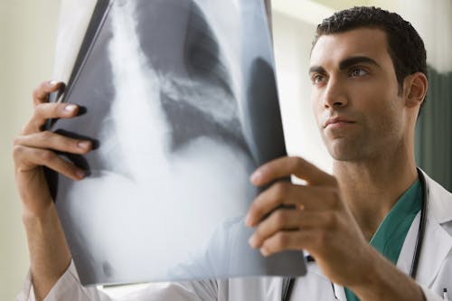 Un metodo per prevedere l’aggressività del tumore del polmone