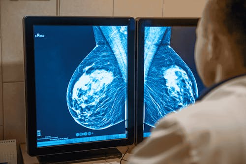 L’intelligenza artificiale entra nello screening mammografico: l’Italia prima in Europa