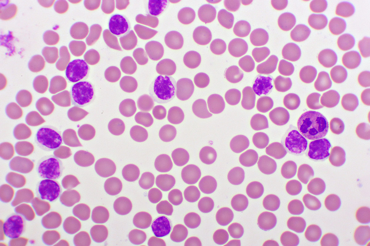 Standard Care: What is the Primary treatment for leukemia in Children? 3 Standard Care: What is the Primary treatment for leukemia in Children?