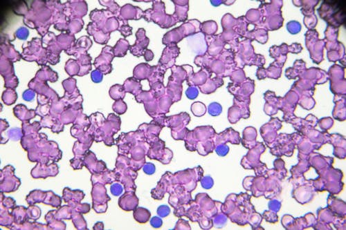 Interrompere il dialogo tra cellule tumorali e linfonodi per battere la leucemia linfatica cronica
