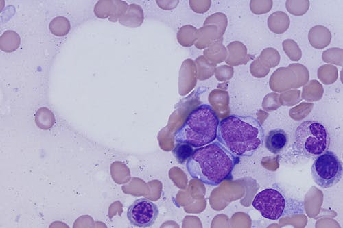 Verso una nuova terapia cellulare contro la leucemia mieloide acuta?