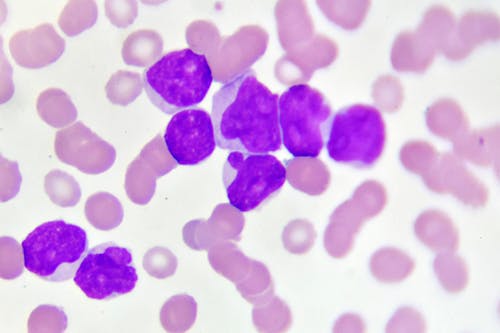 Leucemia mieloide acuta: verso una possibile strategia contro le recidive