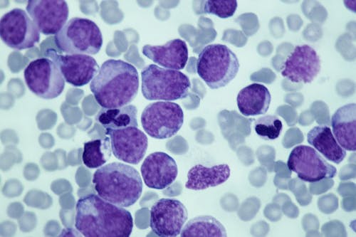 Leucemia mieloide cronica: sospendere la terapia a base di imatinib è possibile, ma con cautela