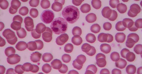 Leucemia a cellule capellute: dal laboratorio al letto del malato il passo è breve