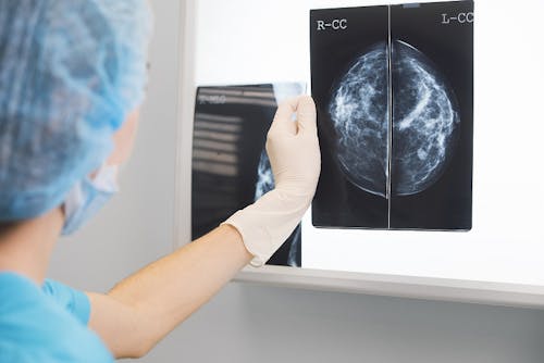 Una firma genetica per scegliere come affrontare il tumore del seno