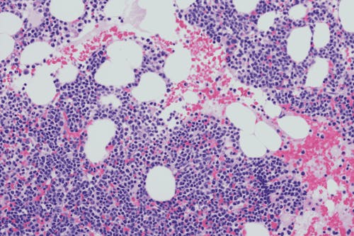 Possibili nuove opzioni per i pazienti con mieloma multiplo