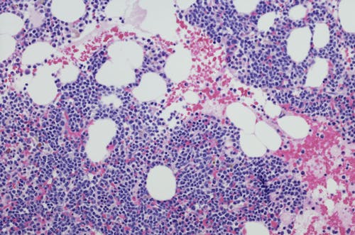 Verso cellule NK sempre più efficaci contro il mieloma multiplo