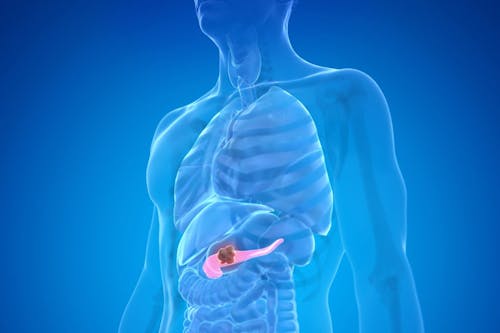 Tumore del pancreas, scoperto un nuovo meccanismo chiave