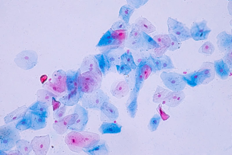 papilloma virus cellule anomale)
