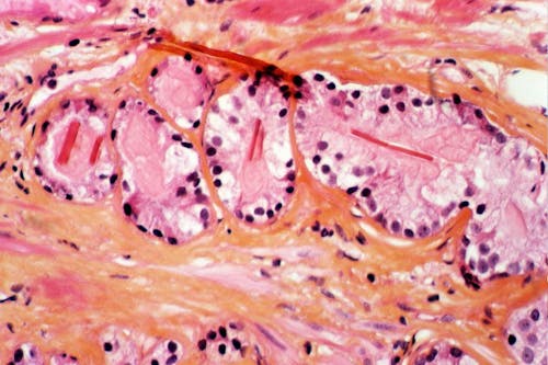 Tumore alla prostata aggressivo: dove non arriva la biopsia, potrebbe arrivare il test NEMO