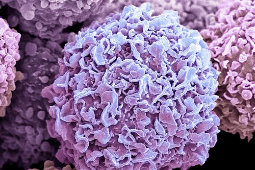 Un nanotaxi specifico contro il tumore del seno triplo negativo