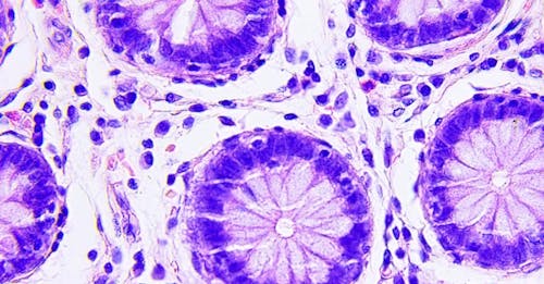Tumore del colon-retto metastatico: ecco come evolvono le forme resistenti ai farmaci anti-HER2