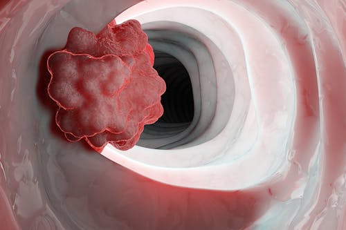 Il ruolo del freno immunitario PD-1 nel tumore del colon-retto