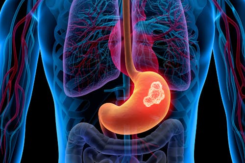 Tumore dello stomaco: prospettive interessanti per gli inibitori di EGFR