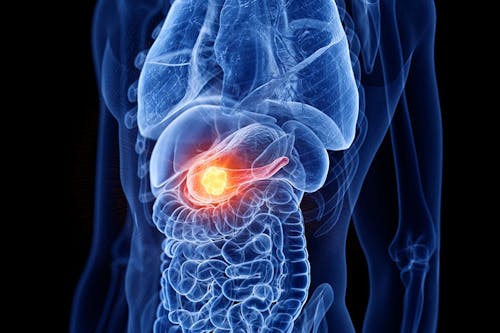 Svelare le componenti del cancro del pancreas, un passo alla volta